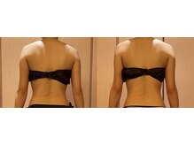 凪 横浜/背中スリム、脇肉スッキリ、肋骨