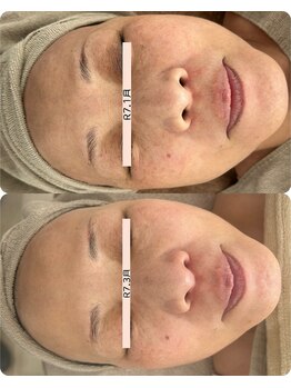 リアン(Lien)/目の周りのくすみの変化に注目