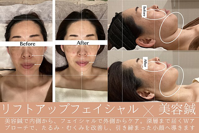 美容鍼+整体 美容鍼・整体サロン京美 院詳細 | 京都市周辺の鍼灸院・美容鍼サロン
