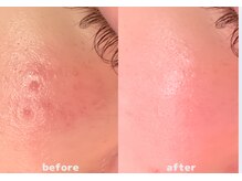 ミエリア美容鍼灸院(mielia美容鍼灸院)/カスタム美容鍼灸→幹細胞導入