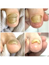 名古屋巻き爪専門Pro/肥厚爪