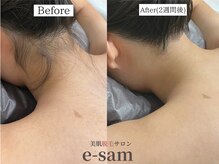 イーサム 高槻摂津富田店(e-sam)/丸ごと全身脱毛