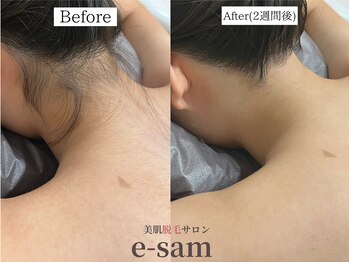 イーサム 高槻摂津富田店(e-sam)/丸ごと全身脱毛