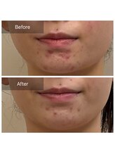 リバース(Rebirth)/次世代ハーブピーリング