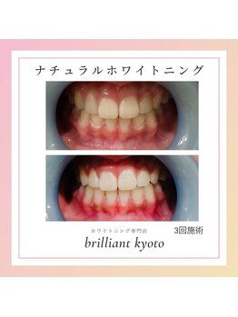 ブリリアント 京都店(Brilliant)/ナチュラルホワイトニング
