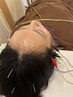 【お試しキャンペーン】美容鍼