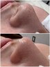 NEW【ポアクラッシュゼロ】小鼻の黒ずみ一掃！小鼻ワックス×全顔光脱毛
