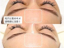 アンシャンテ 神戸元町店(Enchante)/毛穴洗浄ピーリングフェイシャル