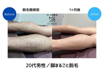 メンズアメリ/高知/メンズ脱毛/ヒゲ/全身/VIO