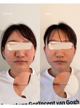 サンク(cinq)/韓国で大人気！インモードリフト