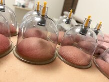 カッピングで代謝を上げて疲労回復♪