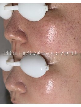 アンドエフ(&F)の写真/アンストレス＋IPLで【肌の土台作り】をし、揺らぎにくい肌へ。