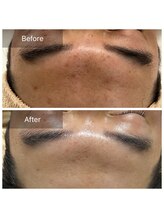 ユカリス(Yu.charis)/ハーブピーリング before/after