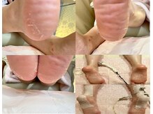 ビサンテ サロン/ガサガサ踵・足裏綺麗,ツルプル1