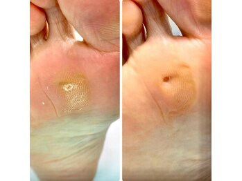 巻き爪補正店 町田店/~タコ・魚の目ケア~