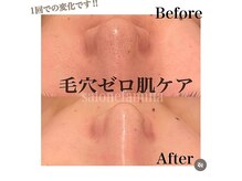 【毛穴レス肌デトックスコース】初回価格￥5,500