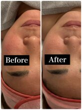 ラナン(Ranan)/ハーブピーリング