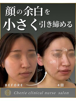 シェリー(Cherie)/20代顔の小顔ケア/余白を小さく