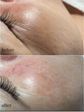 スパークル/毛穴/しわ改善/ワックス脱毛