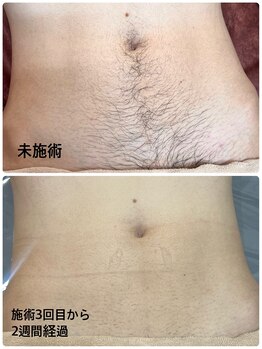 みんなのLED脱毛/20代後半男性・へそ周り脱毛