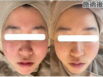 エヴァル 久留米店(ewalu)/ハーブピーリング