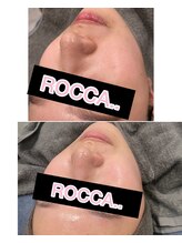 ロッカ(ROCCA..)/ハーブピーリング