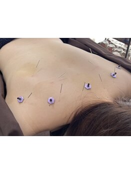 鍼灸施術を受けたい