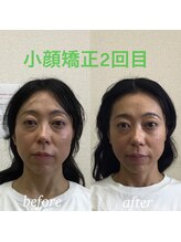 オズ六本木/小顔矯正モニター2回目施術