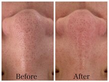 ソア(Soa.)/毛穴コース１回の変化