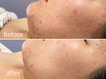 ソレイユ(Soleil)/ニキビ・肌荒れ