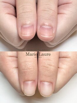 マリーロール 梅田店(Marie Laure)/自爪育成/深爪矯正/ネイルケア