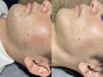 エモーショナル 姫路(Emotional)/ヒゲ脱毛12回の変化