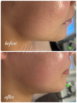 エルール トータルビューティ(Aileure total beauty)/ダウンタイムケア