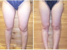 チャルム(CAL'ME)/キャビテーション　３カ月10回