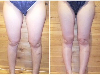 チャルム(CAL'ME)/キャビテーション 3カ月10回