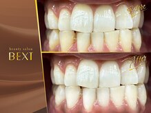 ベクスト(BEXT)/セルフホワイトニング