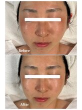 デディア 恵比寿(dedia)/頬のモヤモヤしたシミをケア