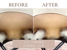 サエラ(SAERA)/うなじ・背中脱毛【5回】