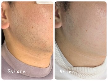 癒し処 ほっこり 海田店/【人気No1】ヒゲ脱毛/20代