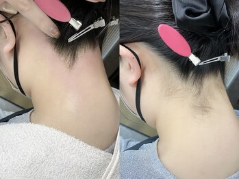 ネリネ 天神(nerine)/うなじワックス☆ワックス脱毛