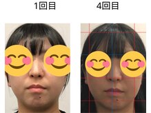 ベル/20代の方の小顔Before After
