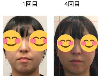 ベル/20代の方の小顔Before After