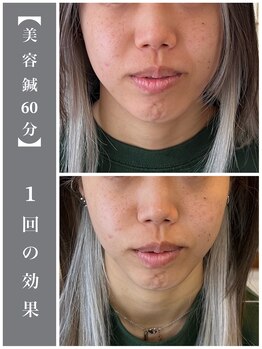 サンクエール 代官山鍼灸院(CINQ AILES)/美容鍼　むくみ・眼精疲労・小顔