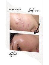 ベル(Belle)/ハーブピーリング￥9,800