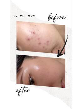 ベル(Belle)/ハーブピーリング￥9,800