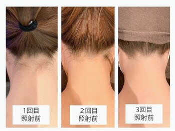 マイフェアレディ 今池(MyFairLady)/特許取得マシン☆美肌脱毛