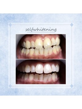 ソレラ(sorelle)/ホワイトニング