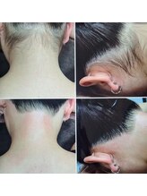 ミラージュ(mirage)/項のワックス脱毛