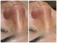 エステティックサロン ベルエトワール住吉店/男性の方にもハイドロ人気です