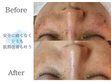 ディアスマイル(Dear.smile)/安全に痛みなくシミも肌質改善も